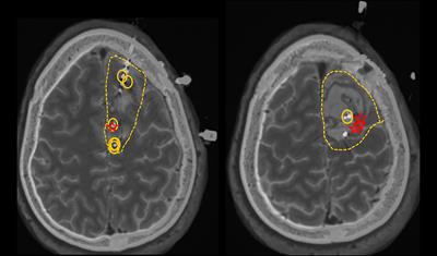 Meningioma Related Epilepsy- Pathophysiology, Pre/postoperative Seizures Predicators and Treatment